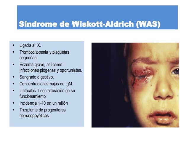 enfermedad de wiskott aldrich